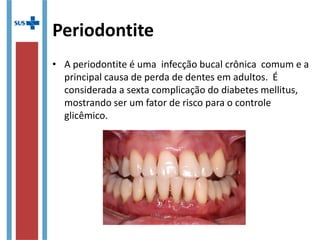 Periodontite
• A periodontite é uma infecção bucal crônica comum e a
principal causa de perda de dentes em adultos. É
considerada a sexta complicação do diabetes mellitus,
mostrando ser um fator de risco para o controle
glicêmico.
 