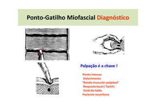 Ponto-Gatilho Miofascial Diagnóstico
Palpação é a chave !
Ponto intenso
Dolorimento
‘Banda muscular palpável’
Resposta local ( Twich)
Sinal do Salto
Paciente reconhece
 