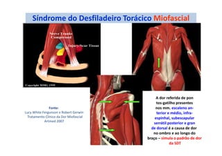 Síndrome do Desfiladeiro Torácico Miofascial
A dor referida de pon
tos-gatilho presentes
nos mm. escaleno an-
terior e médio, infra-
espinhal, subescapular
serrátil posterior e gran
de dorsal é a causa de dor
no ombro e ao longo do
braço – simula o padrão de dor
da SDT
Fonte:
Lucy White Fergunson e Robert Gerwin
Tratamento Clínico da Dor Miofascial
Artmed 2007
 