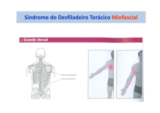 Síndrome do Desfiladeiro Torácico Miofascial
 