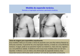 Medida da expansão torácica.
Durante a inspiração aumenta o perímetro torácico.
Teste de triagem para espondilite anquilosante.
Essa medida é feita ao circundar o tórax do paciente com uma fita métrica flexível na
linha dos mamilos. O paciente faz uma expiração máxima, e mede-se a circunferência
torácica. A seguir, pede-se ao paciente inspirar ao máximo e, mais uma vez, registra-
se a circunferência obtida. A distância entre essas duas medidas deve ser de 5cm.
Quando é inferior a 2,5 cm indica uma diminuíção da expansão torácica. Essa
expansão torácica diminuída pode constituir um sinal de espondilite ancilosante.
 