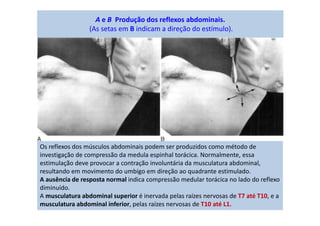 A e B Produção dos reflexos abdominais.
(As setas em B indicam a direção do estímulo).
Os reflexos dos músculos abdominais podem ser produzidos como método de
investigação de compressão da medula espinhal torácica. Normalmente, essa
estimulação deve provocar a contração involuntária da musculatura abdominal,
resultando em movimento do umbigo em direção ao quadrante estimulado.
A ausência de resposta normal indica compressão medular torácica no lado do reflexo
diminuído.
A musculatura abdominal superior é inervada pelas raízes nervosas de T7 até T10, e a
musculatura abdominal inferior, pelas raízes nervosas de T10 até L1.
 