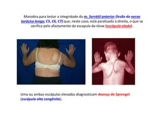 Manobra para testar a integridade do m. Serrátil anterior (lesão do nervo
torácico longo; C5, C6, C7) que, neste caso, está paralisado à direita, o que se
verifica pelo afastamento da escapula do tórax (escápula alada).
Uma ou ambas escápulas elevadas diagnosticam doença de Sprengel
(escápula alta congênita).
 
