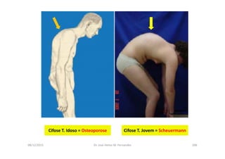 08/12/2015 Dr. José Heitor M. Fernandes 206
Cifose T. Idoso = Osteoporose Cifose T. Jovem = Scheuermann
 