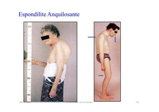 08/12/2015 Dr. José Heitor M. Fernandes 211
Espondilite Anquilosante
 