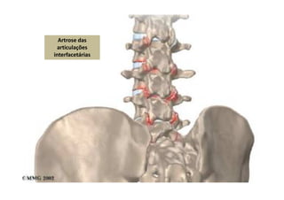 Artrose
Artrose das
articulações
interfacetárias
 