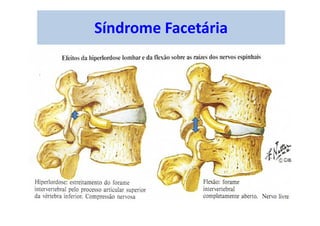 Síndrome Facetária
 