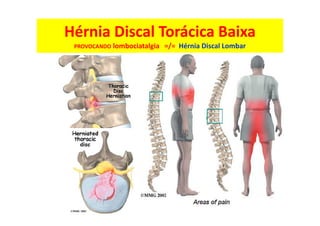 Hérnia Discal Torácica Baixa
PROVOCANDO lombociatalgia =/= Hérnia Discal Lombar
 