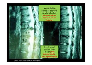 08/12/2015 Dr. José Heitor Machado Fernandes 226
Hérnia discal
Torácica entre
T9-T10 pode
dar dor irradia-
da à região lombar
Nas lombalgias
sem lesão aparente
na coluna lombar,
pesquisar hérnia
discal em Coluna
Torácica !
Fonte: Prof. Dr. Tarcisio EP de Barros Filho
 