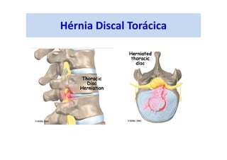Hérnia Discal Torácica
 