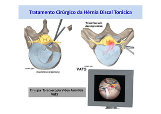 Tratamento Cirúrgico da Hérnia Discal Torácica
Cirurgia Toracoscopia Vídeo Assistida
VATS
 