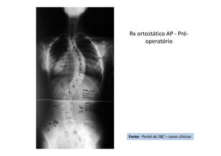 Rx ortostático AP - Pré-
operatório
Fonte: Portal da SBC – casos clínicos
 