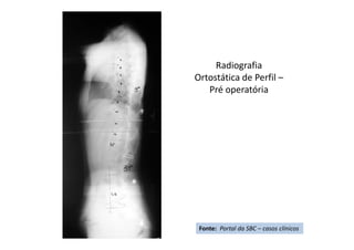 Radiografia
Ortostática de Perfil –
Pré operatória
Fonte: Portal da SBC – casos clínicos
 