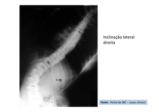 Inclinação lateral
direita
Fonte: Portal da SBC – casos clínicos
 