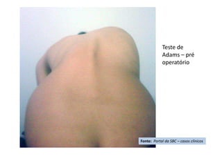 Teste de
Adams – pré
operatório
Fonte: Portal da SBC – casos clínicos
 