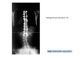 Radiografia pós-operatório -AP
Fonte: Portal da SBC – casos clínicos
 