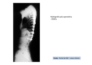 Radiografia pós-operatória
- PERFIL
Fonte: Portal da SBC – casos clínicos
 
