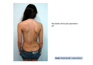 Resultado clínico pós operatório -
AP
Fonte: Portal da SBC – casos clínicos
 