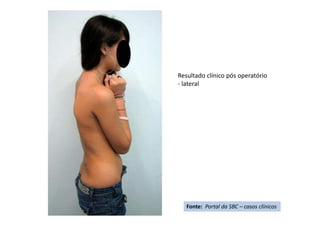 Resultado clínico pós operatório
- lateral
Fonte: Portal da SBC – casos clínicos
 