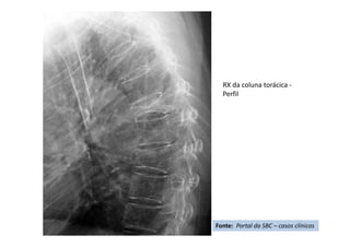 RX da coluna torácica -
Perfil
Fonte: Portal da SBC – casos clínicos
 