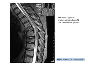 RM - corte sagital de
imagem ponderada em T2
com supressão de gordura
Fonte: Portal da SBC – casos clínicos
 