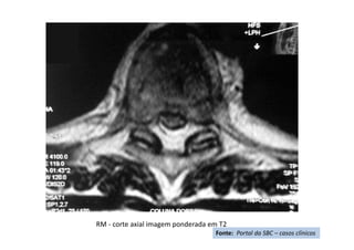 RM - corte axial imagem ponderada em T2
Fonte: Portal da SBC – casos clínicos
 