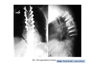 RX – Pós-operatório 4 meses
Fonte: Portal da SBC – casos clínicos
 