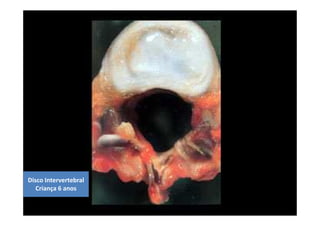 08/12/2015 Dr. José Heitor Machado Fernandes 280
Disco Intervertebral
Criança 6 anos
 