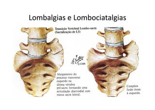 Lombalgias e Lombociatalgias
 