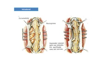 figura
Intradural
 