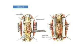 figura
Intradural
 
