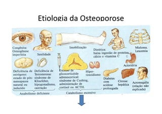 Etiologia da Osteoporose
 