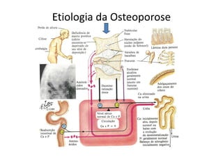 Etiologia da Osteoporose
 