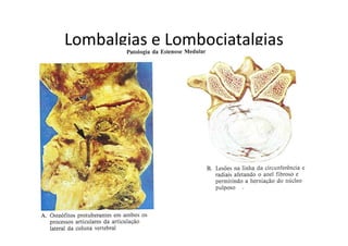 Lombalgias e Lombociatalgias
 