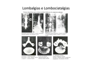 Lombalgias e Lombociatalgias
 