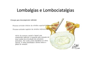 Lombalgias e Lombociatalgias
 