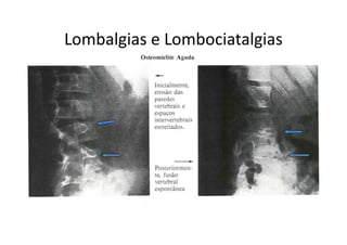 Lombalgias e Lombociatalgias
 