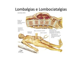 Lombalgias e Lombociatalgias
 