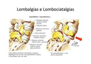 Lombalgias e Lombociatalgias
 