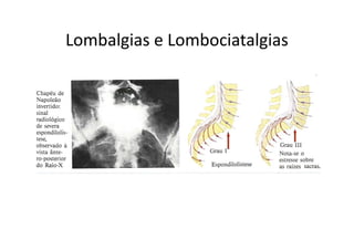 Lombalgias e Lombociatalgias
 