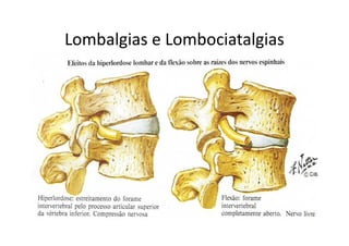 Lombalgias e Lombociatalgias
 
