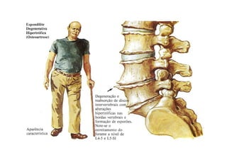 figura
Lombalgias e Lombociatalgias
 