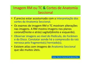 Imagem RM ou TC & Cortes de Anatomia
Seccional
• É preciso estar acostumado com a interpretação dos
cortes da Anatomia Seccional.
• Os exames de imagem RM e TC mostram alterações
nas imagens. A RM mostra imagens nos planos
coronal(frente e atrás) sagital(direito e esquerdo).
• Observar imagens ao nível do Pedículo, do Forâmen
e do Disco. Constatar aonde há a compressão da raiz
nervosa pelo fragmento(s) herniado(s).
• Existem atlas com imagens de Anatomia Seccional
que são muitos úteis.
Fonte: Prof. Dr. Tarcisio EP de Barros Filho
 