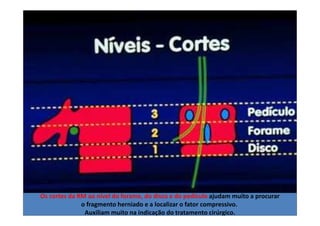 08/12/2015 Dr. José Heitor Machado Fernandes 385
Os cortes da RM ao nível do forame, do disco e do pedículo ajudam muito a procurar
o fragmento herniado e a localizar o fator compressivo.
Auxiliam muito na indicação do tratamento cirúrgico.
 