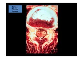 08/12/2015 Dr. José Heitor Machado Fernandes 388
Corte ao
Nível do
Forame
 