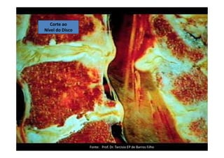 08/12/2015 Dr. José Heitor Machado Fernandes 390
Corte ao
Nível do Disco
Fonte: Prof. Dr. Tarcisio EP de Barros Filho
 