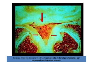 08/12/2015 Dr. José Heitor Machado Fernandes 392Corte de Anatomia Seccional mostrando compressão do Canal por dicopatia e por
compressão do ligamento amarelo.
 