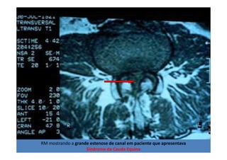 08/12/2015 Dr. José Heitor Machado Fernandes 393RM mostrando a grande estenose de canal em paciente que apresentava
Síndrome da Cauda Equina
 