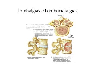 Lombalgias e Lombociatalgias
 