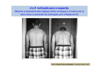 A e B Inclinação para a esquerda.
Observe a assimetria dos espaços entre os braços e o tronco em A,
bem como o aumento da inclinação com a flexão em B.
Reider, O Exame Físico em Ortopedia – Guanabara Koogan -2001
 